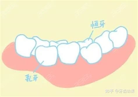 儿童双排牙一定要拔除吗没想到双排牙的危害竟然这么大 知乎