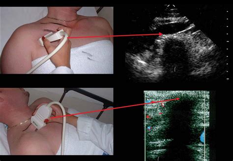 Sonography Of The Peripheral Veins Lange Review Ultrasonography