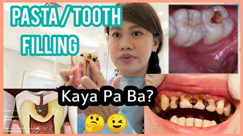 Malaking Sira Ng Ngipin Kaya Pa Ba Pastahan Tooth Filling Dental