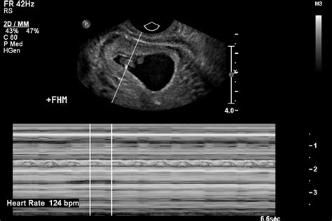 Cesarean Scar Ectopic Pregnancy Applied Radiology