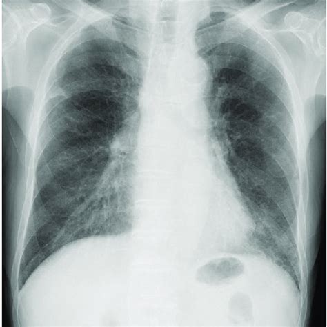 Chest Radiograph On Admission Showing Ground Glass Opacities In The Download Scientific Diagram