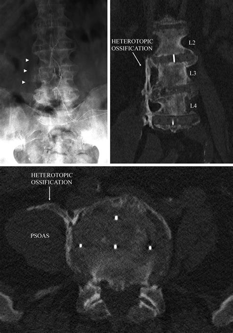 Symptomatic Heterotopic Bone Formation After Rhbmp 2 Utilization In Lateral Lumbar Interbody