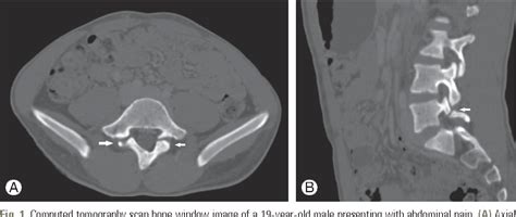 Figure From Facture Of The Pars Interarticularis With Or Without