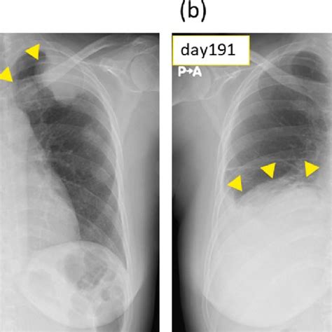 Effect Of Pazopanib Resumption On Lung Metastatic Tumors Chest X Rays