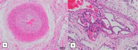 Pulmonary Artery Histology