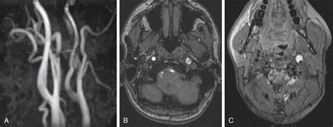 cervical artery dissection clinical tree