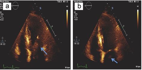 Transthoracic Echocardiogram Showing Large Mobile Density Within Left