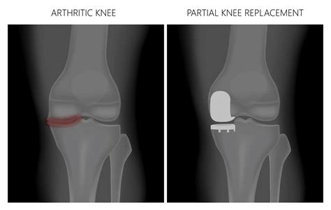 Partial Knee Surgery EmergeOrthoTriangle Region