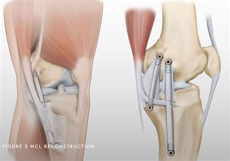 Lesion del Ligamento colateral medial Dr Martín Estevez