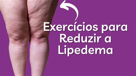 Exercícios para Reduzir a Lipedema Respondendo suas Dúvidas YouTube