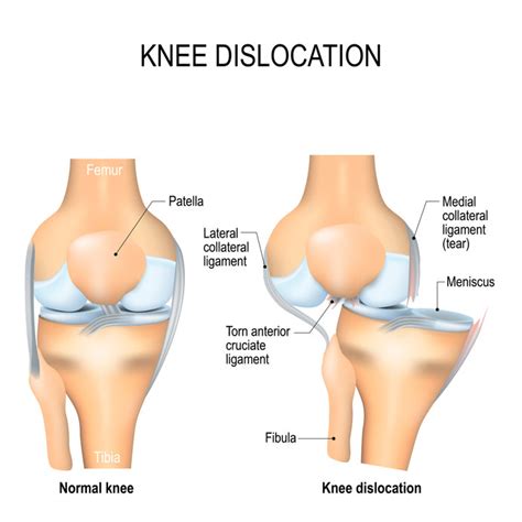 Dislocated knee and dislocations of the patella