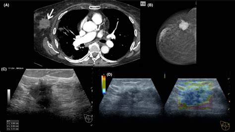 Suspicious Breast Lesions Incidentally Detected On Chest Computer