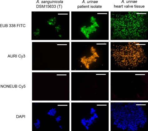 Aerococcus urinae - A potent biofilm builder in endocarditis ...