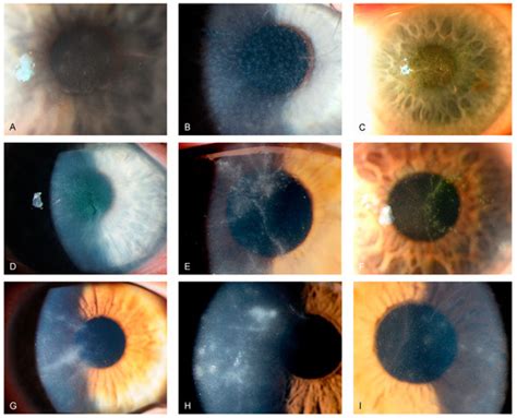 Microorganisms Free Full Text Assessing Pcr Positive Acanthamoeba Keratitis—a Retrospective