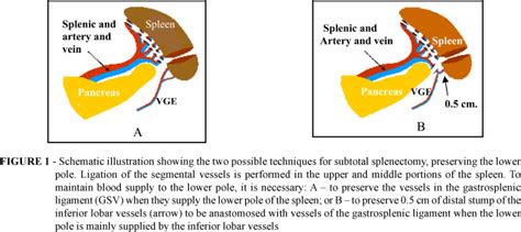 Scielo Brasil Subtotal Splenectomy Preserving The Lower Pole In