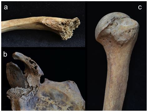 Osteolytic and mixed (blastic and lytic) lesions on the right upper ...