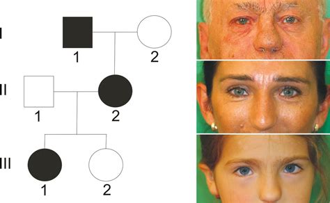 Spectrum Of Novel Mutations Found In Waardenburg Syndrome Types 1 And 2 Implications For