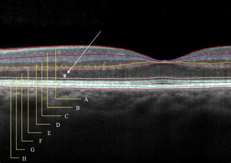 Hyperreflective Dots In The Avascular Outer Retina In Relapsing