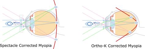 Myopia Control Eye Test And Vision Care Infocus Optical