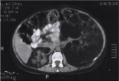 Figure From A Rare Case Of Giant Renal Angiomyolipoma In A Woman With