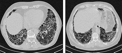 Usual Interstitial Pneumonia Uip And Idiopathic Pulmonary Fibrosis Ipf