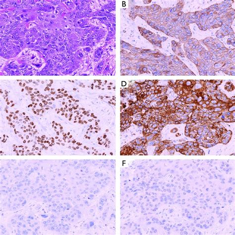 Representative Immunohistochemical Staining For Poorly Differentiated Download Scientific