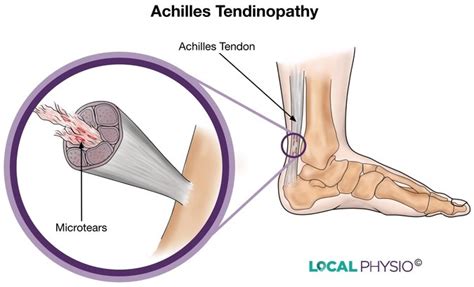 Understanding Achilles Tendinopathy Achilles Tendinitis Atelier Yuwaciaojp