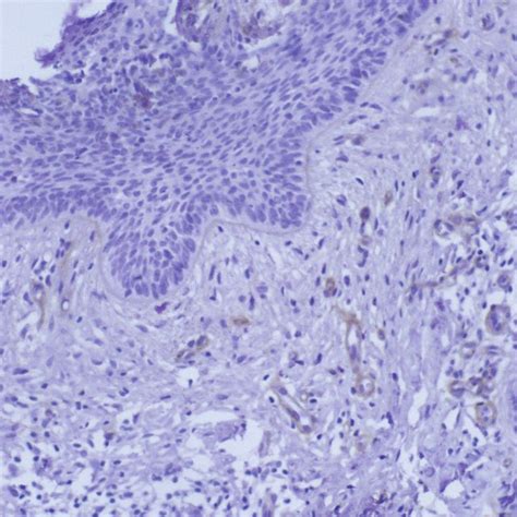 A Basal Cell Carcinoma Superficial Multicentric Type Linear