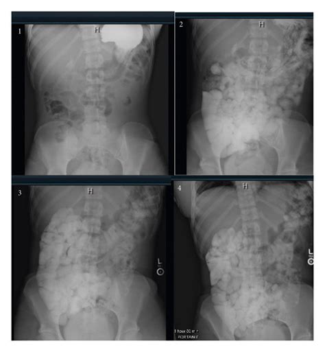 Upper Gastrointestinal Study With Small Bowel Follow Through Revealing