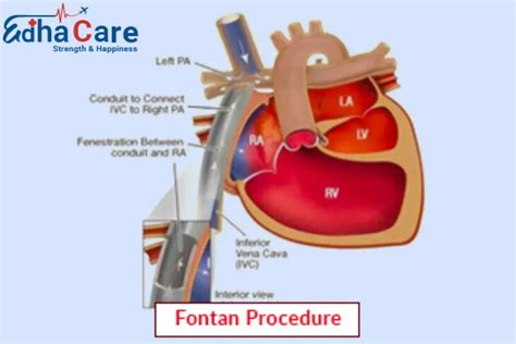 Fontan Procedure | Fontan Surgery | Fontan Operation | EdhaCare