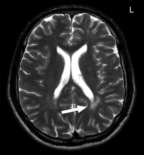 T2 Weighted Magnetic Resonance Image Of A 31 Year Old Female Patient Download Scientific