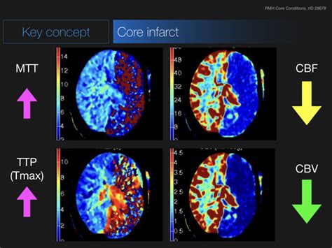 CT Perfusion In Ischemic Stroke Radiology Reference Article