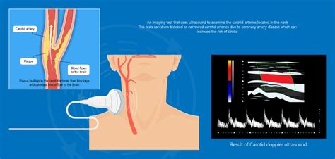Carotid Duplex Doppler Artery Ultrasound Disease Diagnosis, 44% OFF