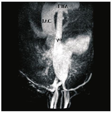 Contrast Enhanced Thoraco Abdominal Mra In The Arterial Phase