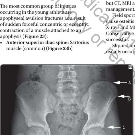 Radiograph Demonstrating The Possible Sites Of Apophyseal Avulsion