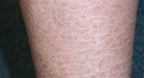 Ichthyosis Vulgaris And Diet Is There A Connection Dry Skin Remedies Dry Skin Legs Ichthyosis