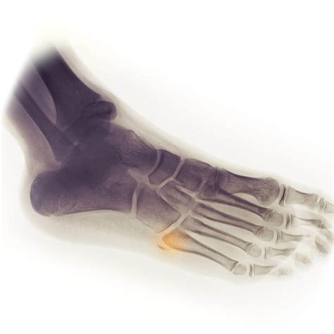 Foot Fractures - Brighton Foot and Ankle