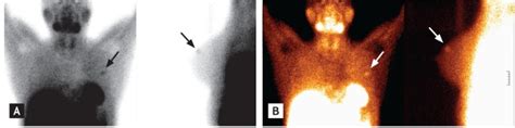 A Mtc Sestamibi Scan Of The Breast Demonstrating Abnormal Uptake