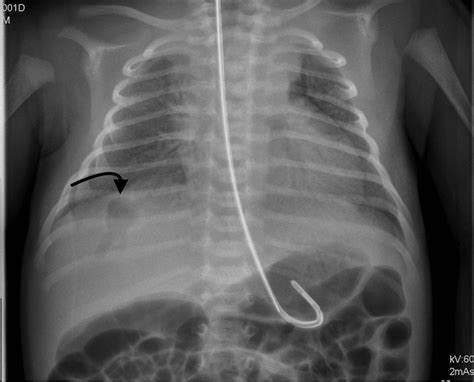 Rare And Unexpected Complication After A Malpositioned Nasogastric Tube