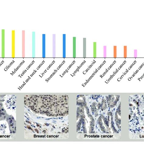 Usp Is Highly Expressed In Cancer A Usp Expression Analysis Of