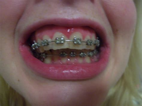 My Jaw Surgery Story: 1 month of braces