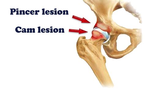 pincer cam hip arthroscopy kochi hip pain - DOCJOINTS//DR SUJIT JOS ...