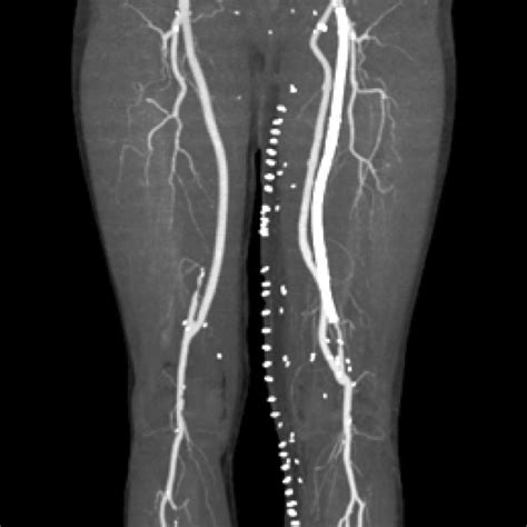 Femoral Artery Stent