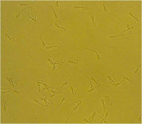 Ab Hypo Osmotic Swelling Of Spermatozoa Evident By Coiled Tails And