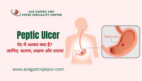 Peptic Ulcer Hindi पेट में अल्सर क्या है जानिए कारण लक्षण और उपाय