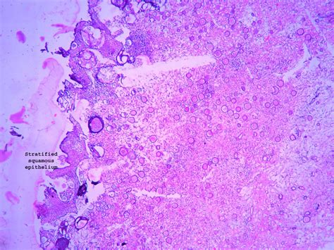 RHINOSPORIDIOSIS – Histopathology.guru