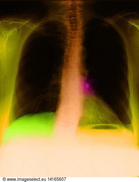 X Ray Of Calcified Hilar Lymph Nodes X Ray Of Calcified Hilar Lymph