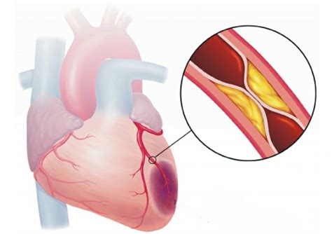 Isquemia Miocárdica O Que é Sintomas E Tratamentos Dicas De Saúde