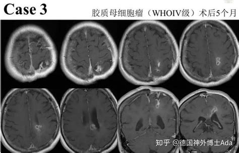 Mr图谱 放射性脑损伤 Vs 胶质瘤复发 知乎