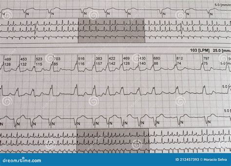 Elettrocardiogramma Con Aritmia Cardiaca Paziente Con Fibrillazione